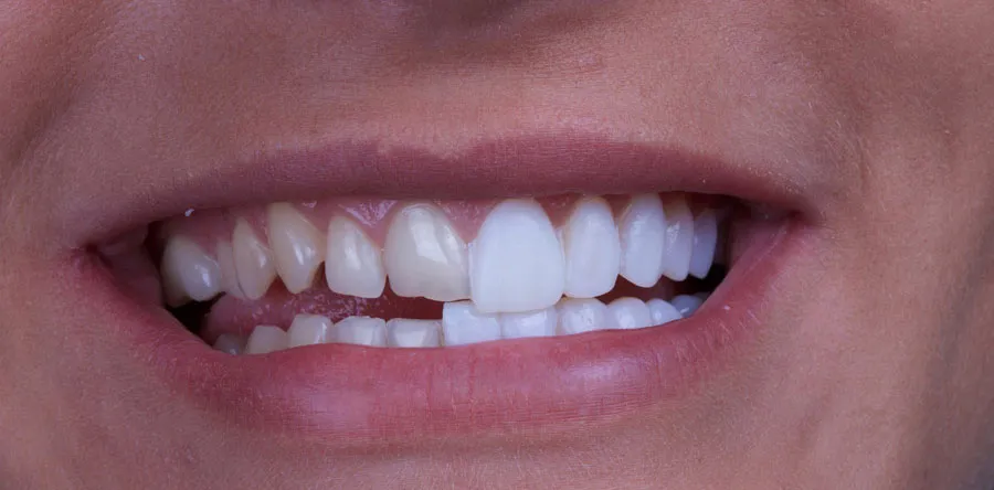 Pros and Cons of Dental Veneers